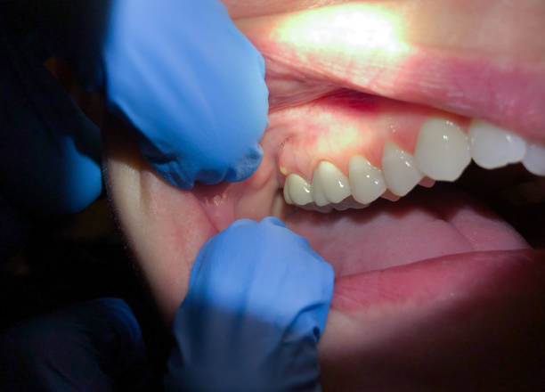 Best Emergency Tooth Extraction in Hancock, MD